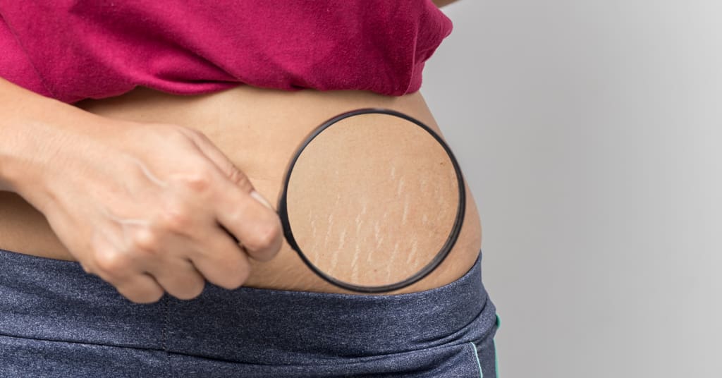 Scar & Stretch Mark Correction