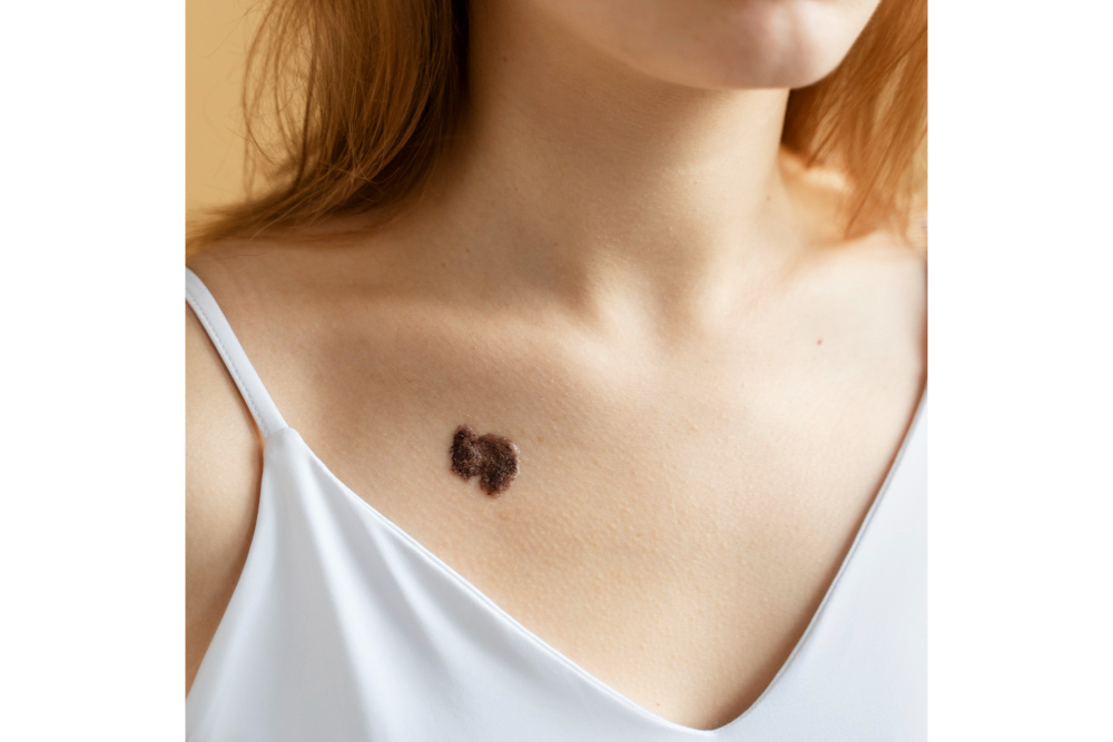 Scar Camouflage Treatment in Pune