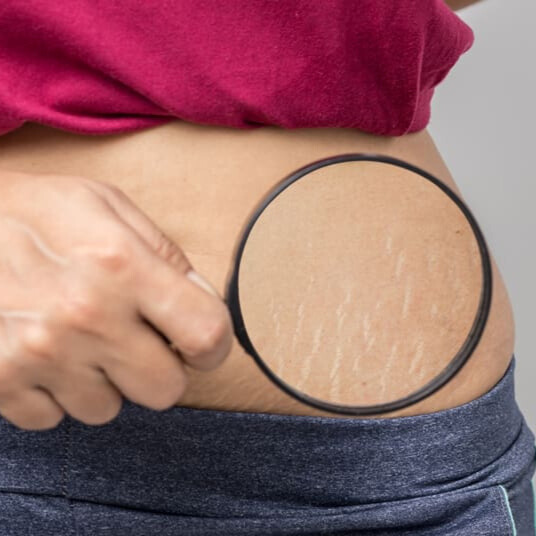 Stretch marks camouflage treatment in Pune reduces the visibility of stretch marks using advanced micropigmentation techniques for smoother, even-toned skin.