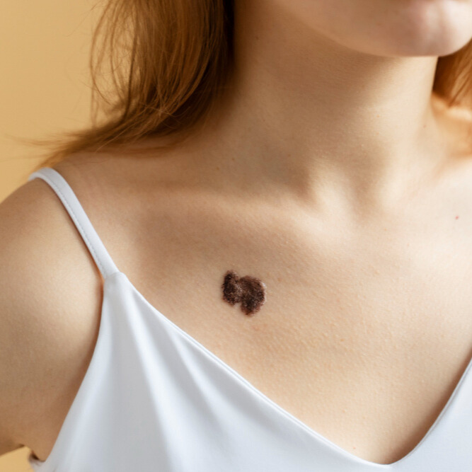 Scar Camouflage Treatment in Pune – Advanced Solution for Concealing Scars