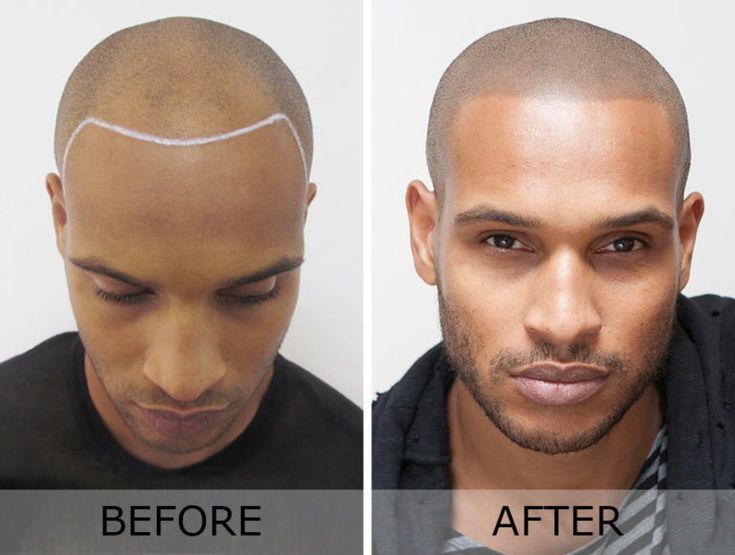 SCALP MICRO PIGMENTATION