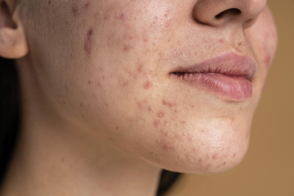 scar blending treatment results