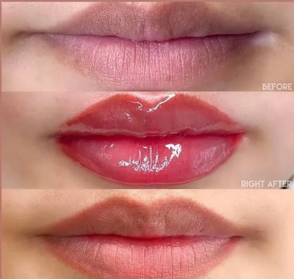 lip neutralization