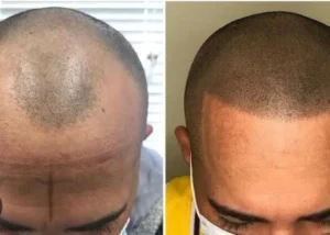 scalp-micropigmenation