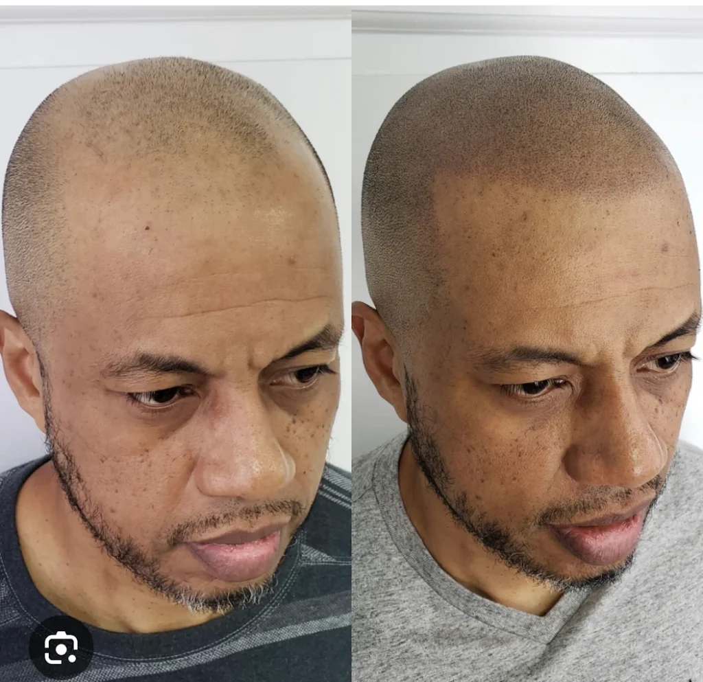 scalp micropigmentation