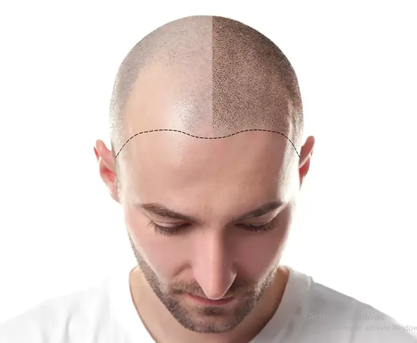 smp treatment in pune