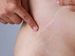 stretch marks camouflage treatment