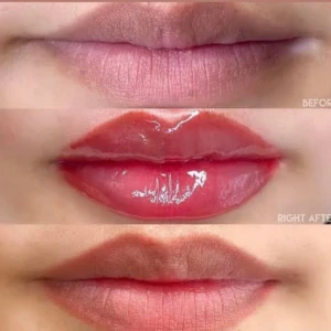lip neutralization
