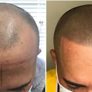 scalp-micropigmenation