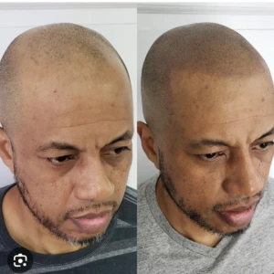 scalp micropigmentation